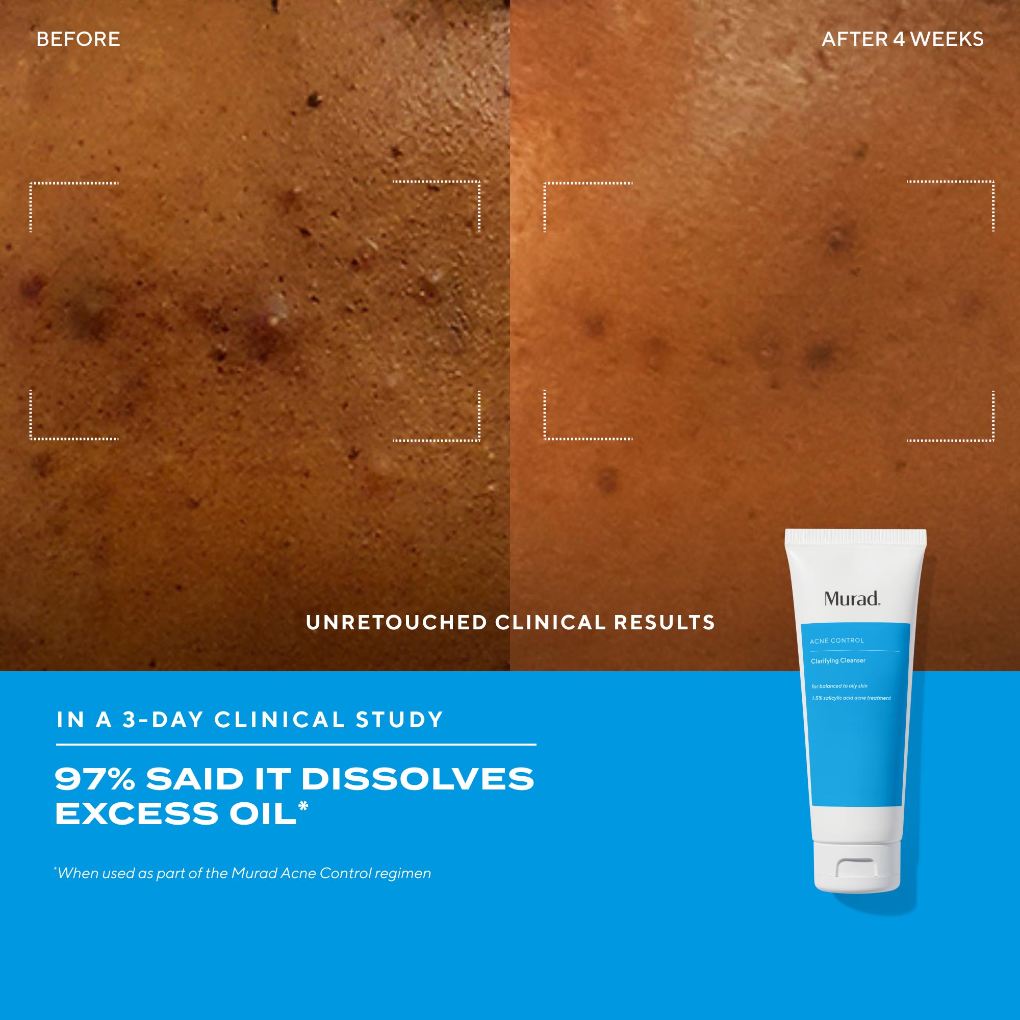 Acne Control Clarifying Cleanser