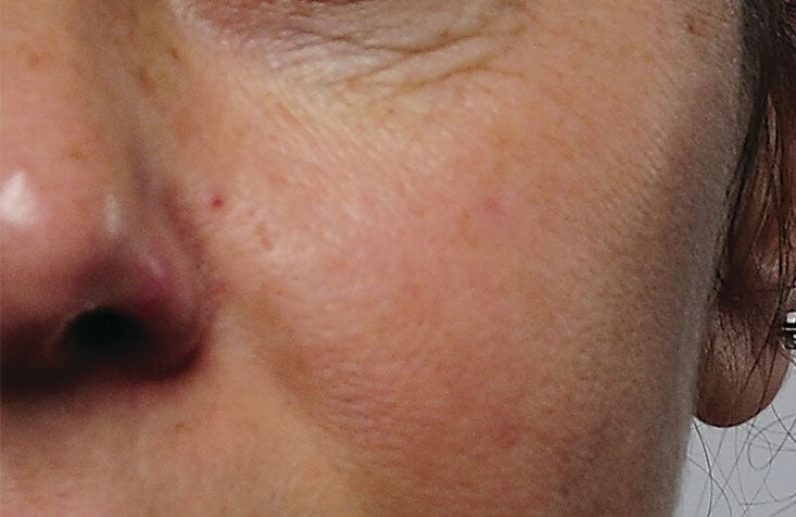 Rapid_Collagen_Infusion_Before_733x476_4333902d-a2a0-4694-8c60-1d2dde8f56c5