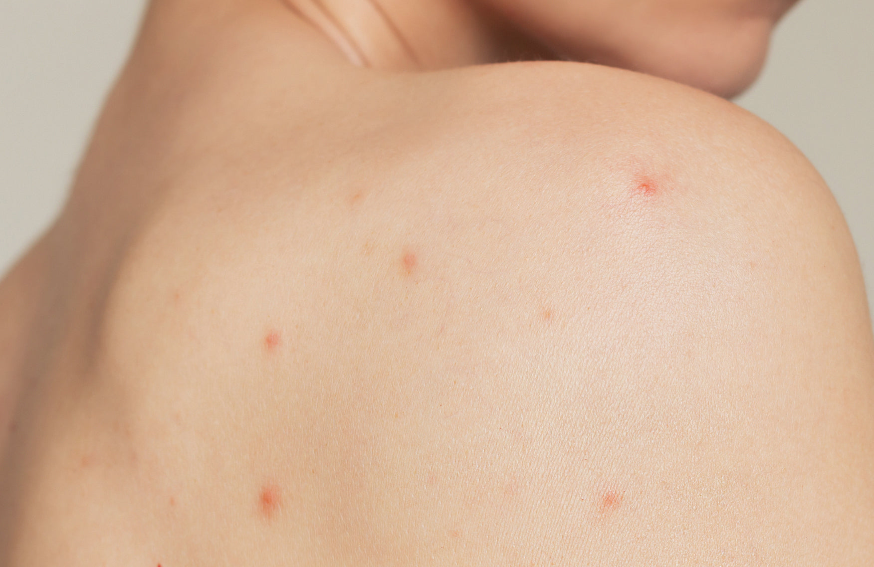 How To Get Rid of Back Acne