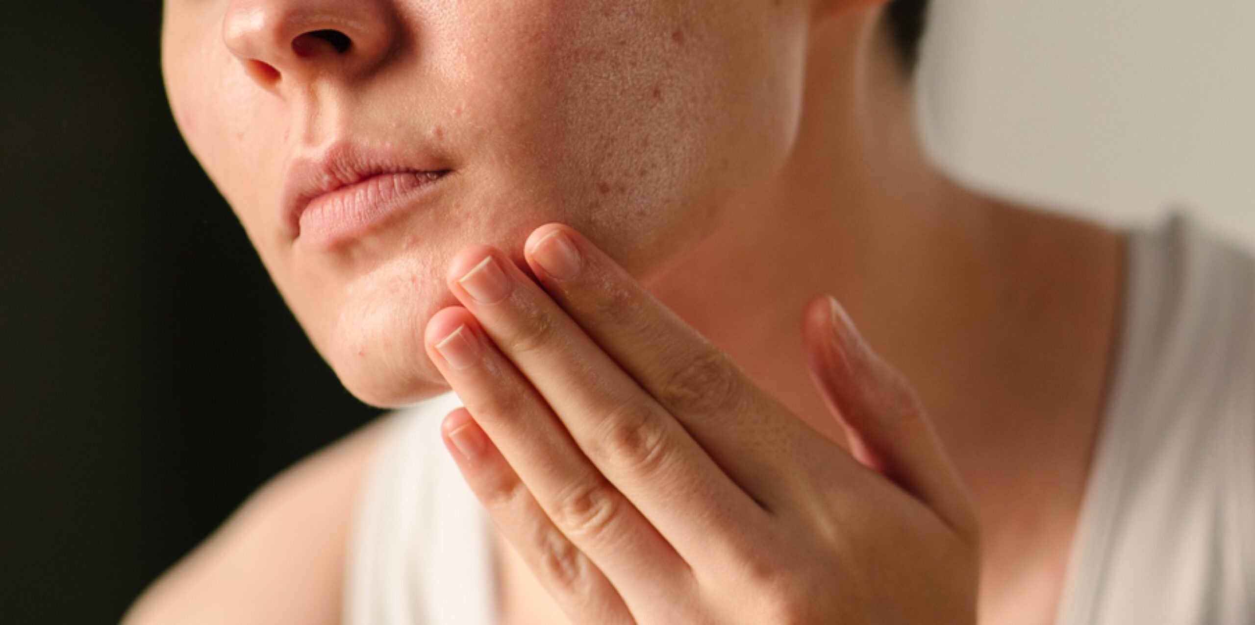 Have breakouts that won’t clear? It might not be acne. Meet the common 'acne imitators'—and how to treat them