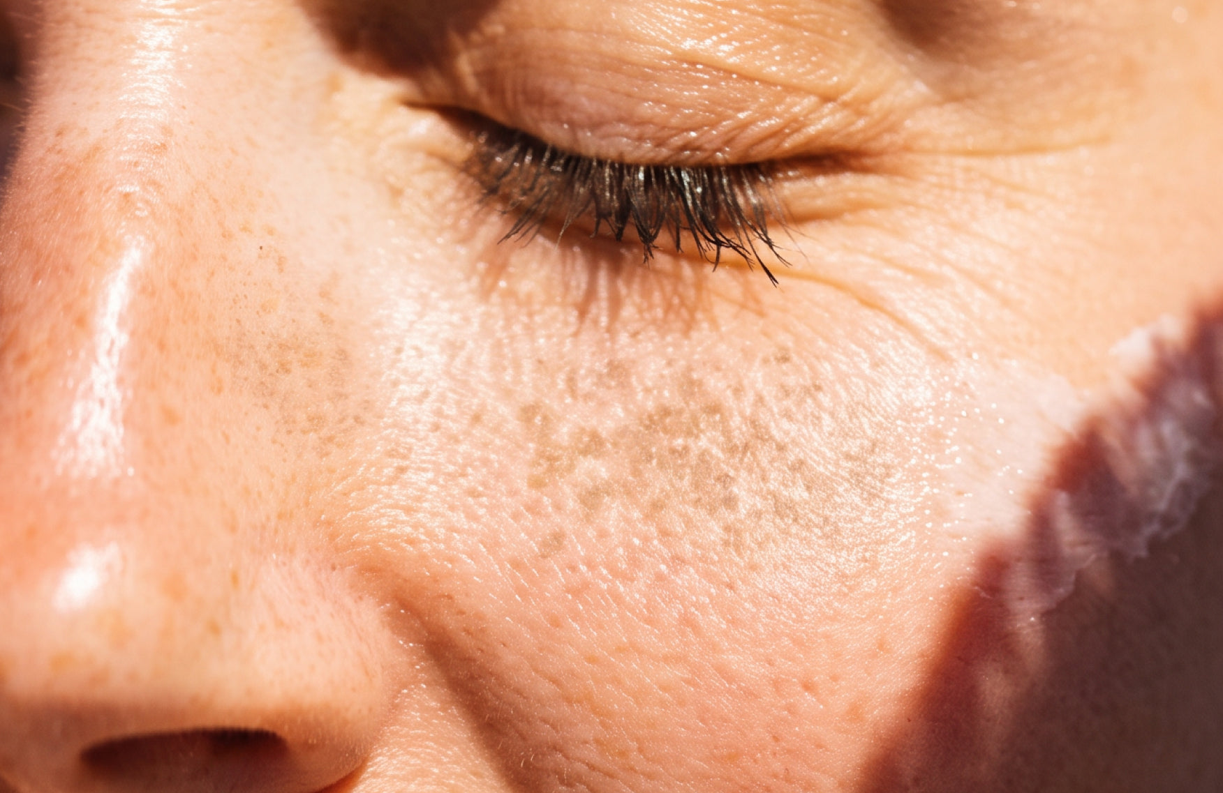 Dark spots, explained: What causes hyperpigmentation, and how do you treat it?