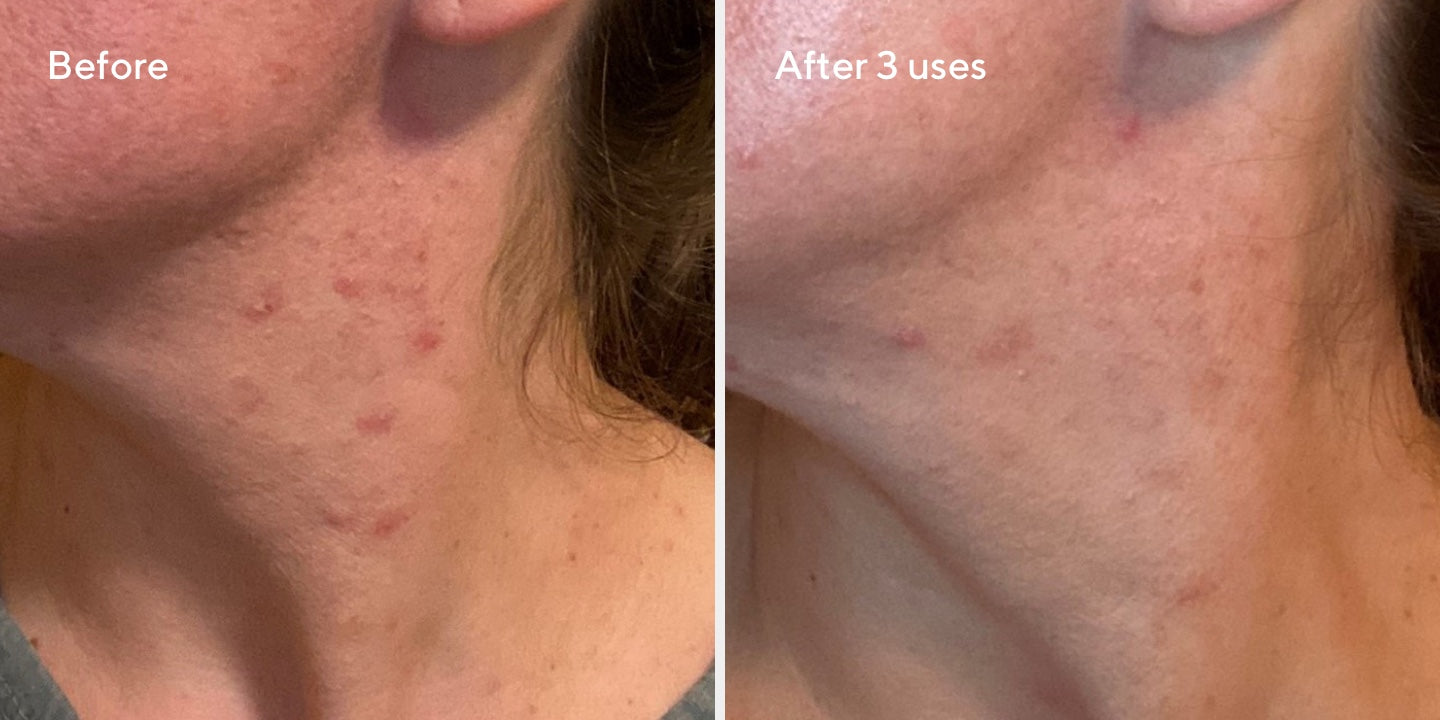 Rapid Relief Sulfur Mask B&A 3
