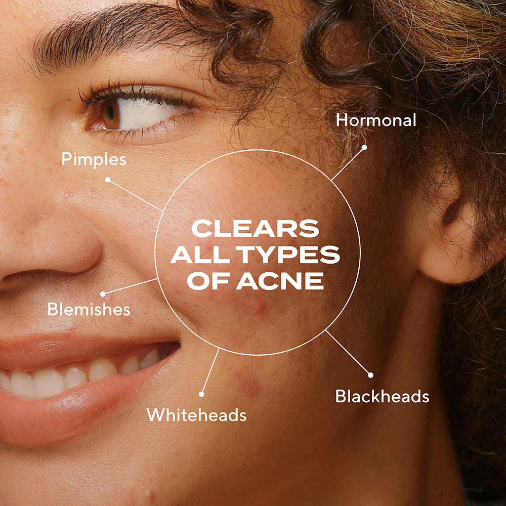 Biome-Balancing Clear & Prevent Acne Treatment Serum
