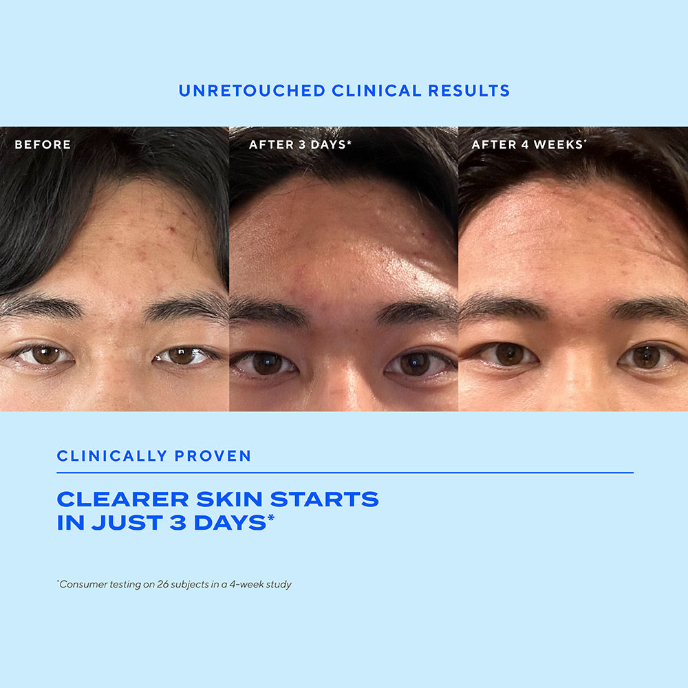 Biome-Balancing Clear & Prevent Acne Treatment Serum