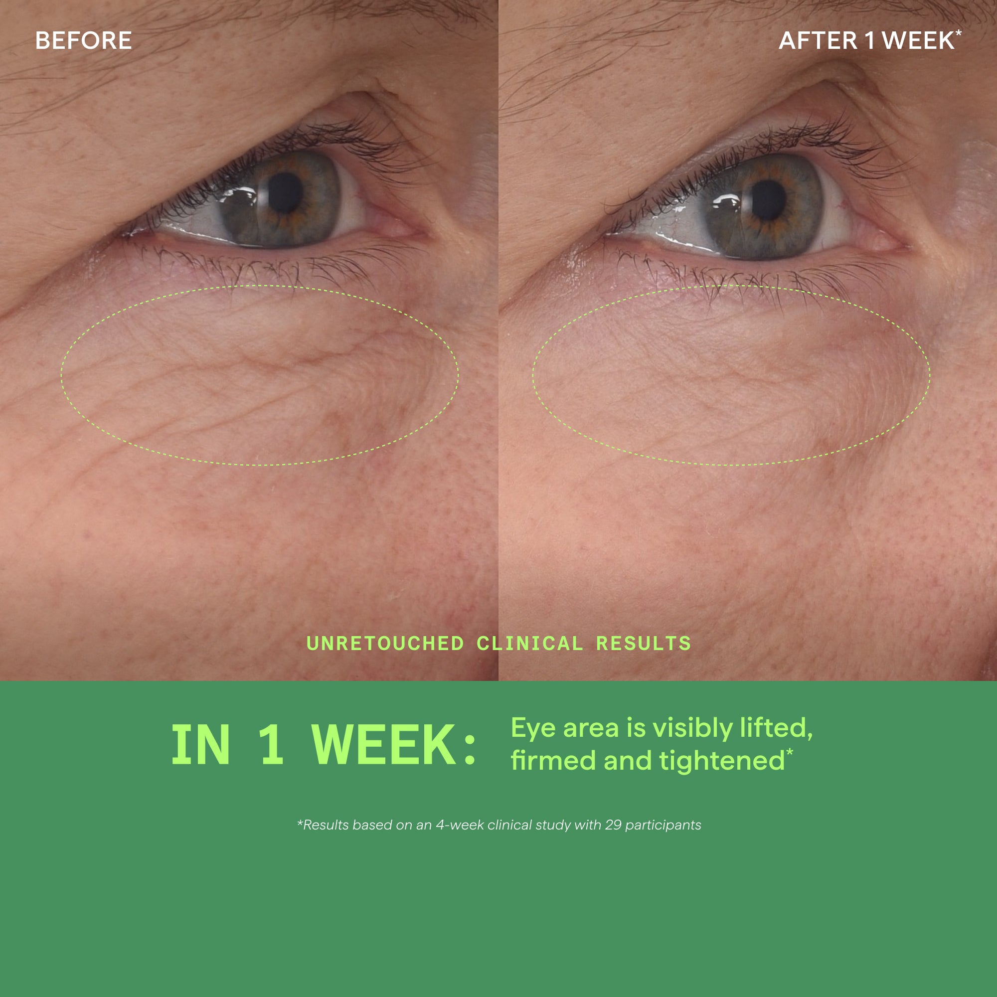 Retinal ReSculpt Eye Lift Treatment