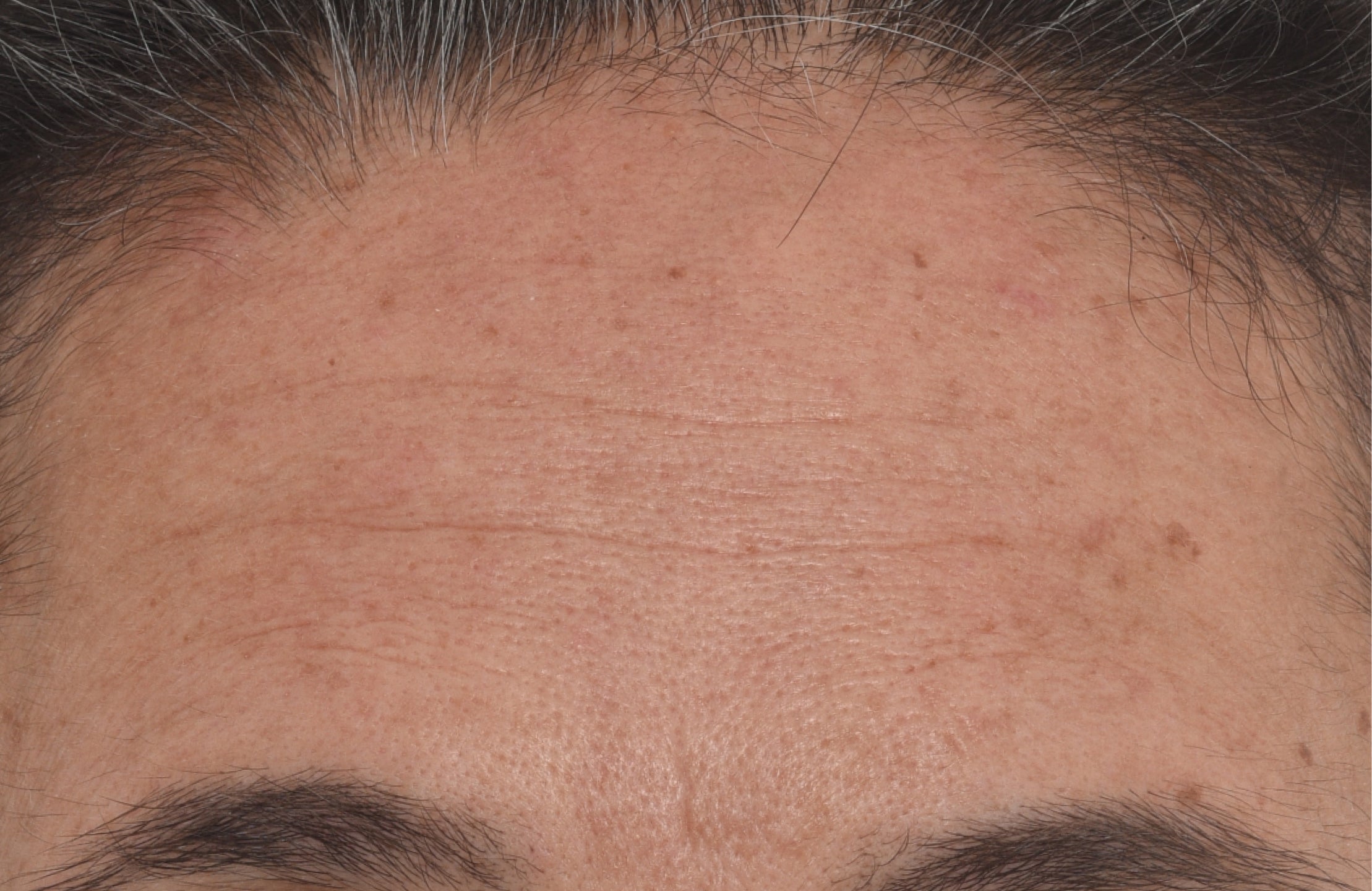 Close-up of a person's forehead showing skin texture, wrinkles, and sparse gray hair at the hairline.