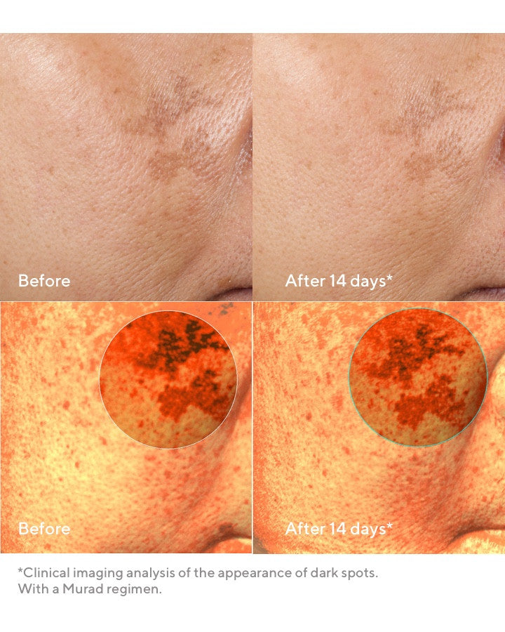 Rapid Dark Spot Correcting Serum Before and After Comparison 2