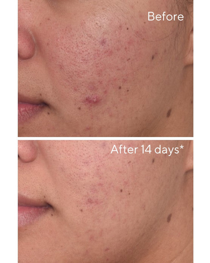 Rapid Dark Spot Correcting Serum Before and After Comparison 3