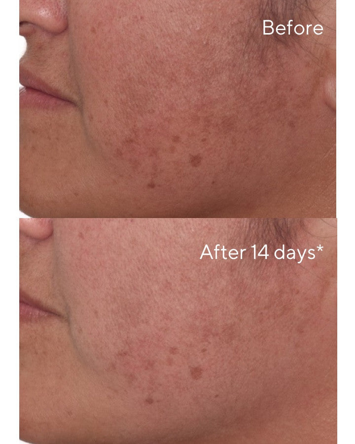 Rapid Dark Spot Correcting Serum Before and After Comparison