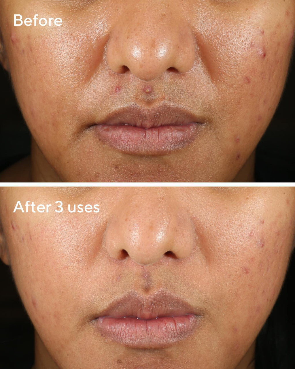 Rapid Relief Acne Sulfur Mask B&A
