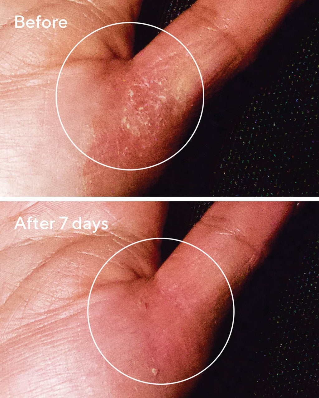 Eczema Treatment Product | Quick Relief Colloidal Oatmeal