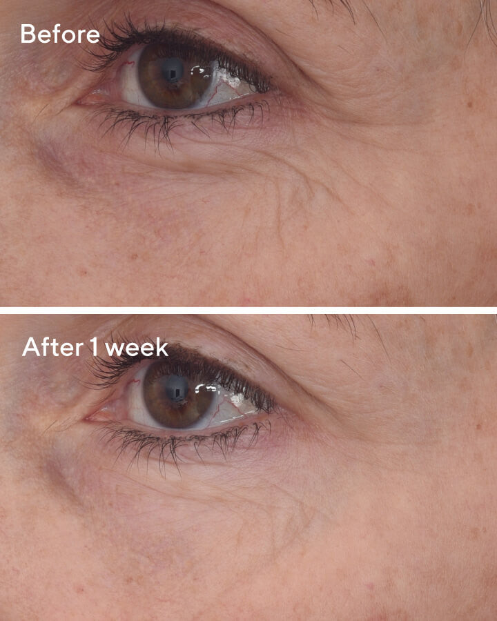 Retinal ReSculpt Eye Lift Treatment - B&A